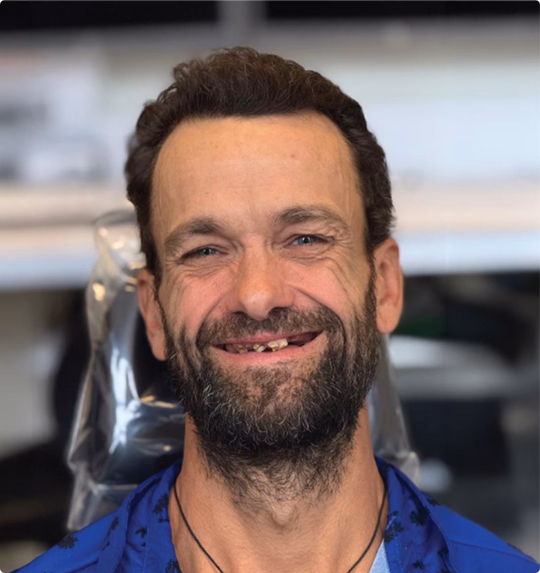 Smile before dental implants
