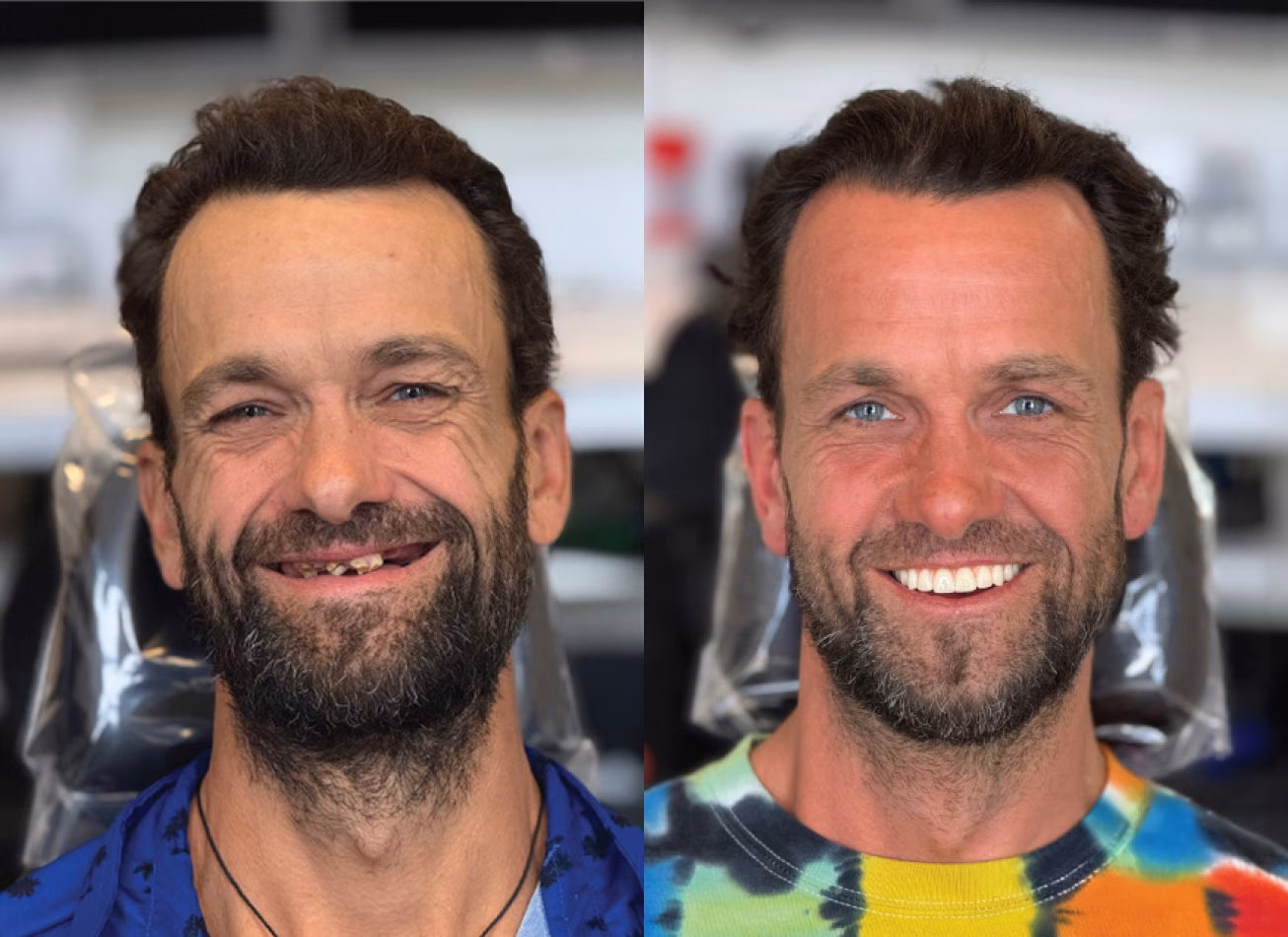 Before and after smile transformation