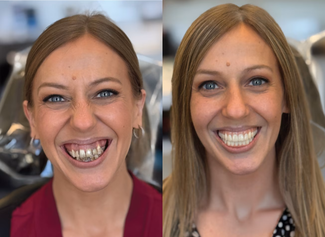 Before and after smile transformation